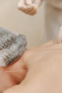 acupuncture has mainstream acceptance in many parts of the world